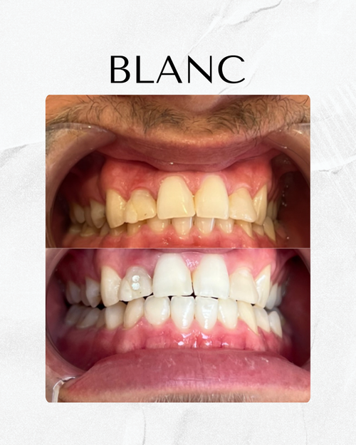 Blanc before and after teeth whitening result