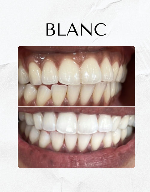 Blanc teeth whitening smile result