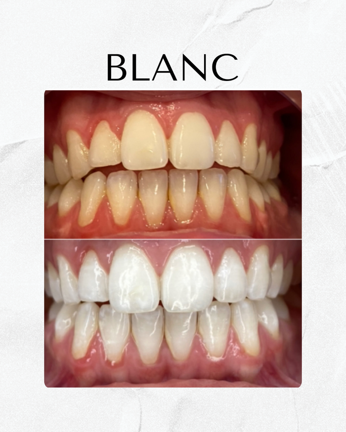 Teeth whitening training at Blanc Academy